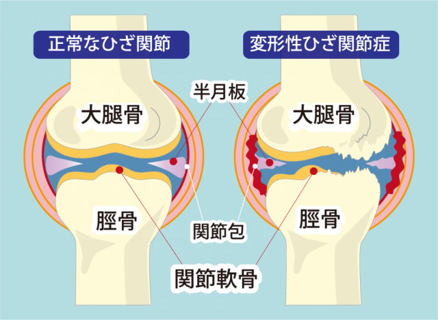 変形性膝関節症とは?